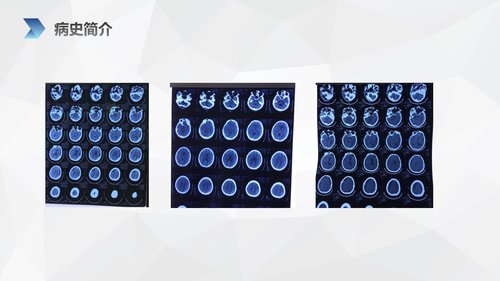 a0152 亚急性硬膜下血肿护理查房PPT课件38页可编辑无水印直接可用 第5页