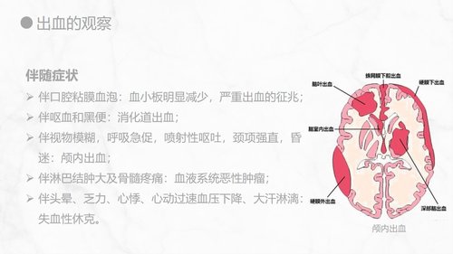 a0155 出血的观察和护理知识PPT课件21页可编辑无水印直接可用 第10页