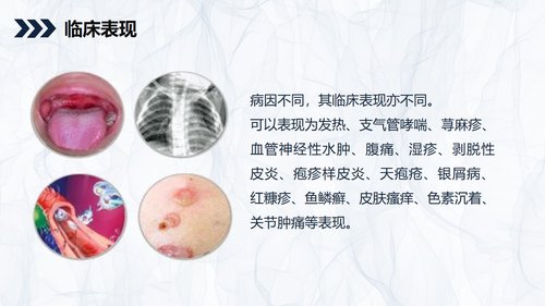 a0166 嗜酸细胞增多症的护理查房知识PPT课件34页可编辑无水印直接可用 第7页