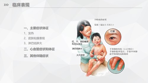 a0169 川崎病儿科护理业务知识PPT课件33页可编辑无水印直接可用 第5页