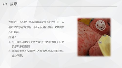 a0169 川崎病儿科护理业务知识PPT课件33页可编辑无水印直接可用 第13页