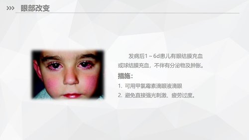 a0169 川崎病儿科护理业务知识PPT课件33页可编辑无水印直接可用 第15页