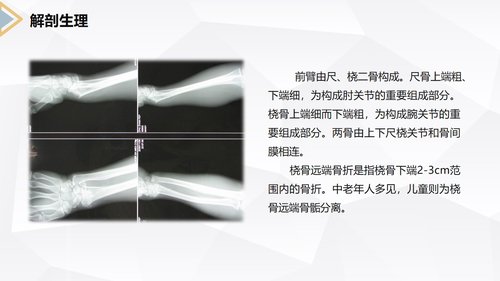 a0171 左桡尺骨双骨折的护理查房PPT课件24页可编辑无水印直接可用 第8页