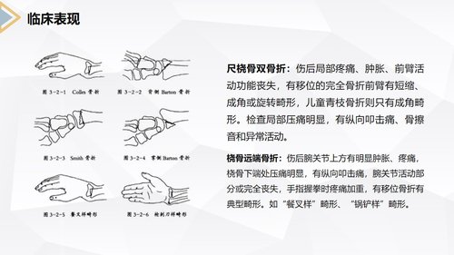 a0171 左桡尺骨双骨折的护理查房PPT课件24页可编辑无水印直接可用 第10页