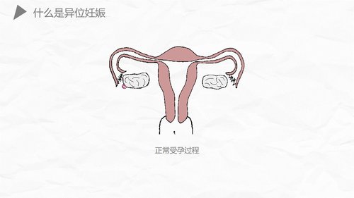 a0174 异位妊娠护理PPT课件27页可编辑无水印直接可用 第8页