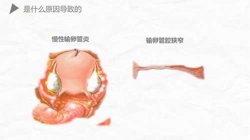 a0174 异位妊娠护理PPT课件27页可编辑无水印直接可用 第13页