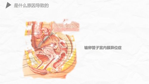 a0174 异位妊娠护理PPT课件27页可编辑无水印直接可用 第14页