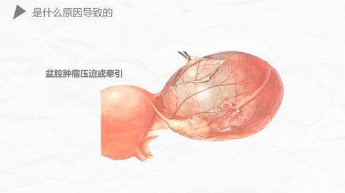 a0174 异位妊娠护理PPT课件27页可编辑无水印直接可用 第15页