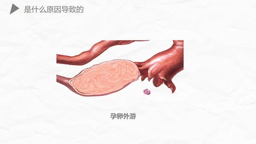 a0174 异位妊娠护理PPT课件27页可编辑无水印直接可用 第16页