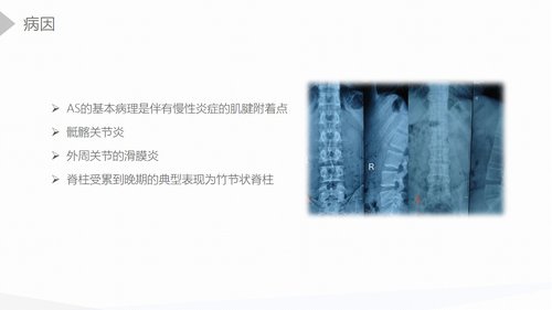 a0175 强直性脊柱炎的护理查房PPT课件45页可编辑无水印直接可用 第6页