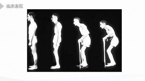 a0175 强直性脊柱炎的护理查房PPT课件45页可编辑无水印直接可用 第7页