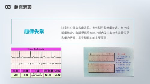 a0177 急性心梗护理查房PPT课件24页可编辑无水印直接可用 第15页