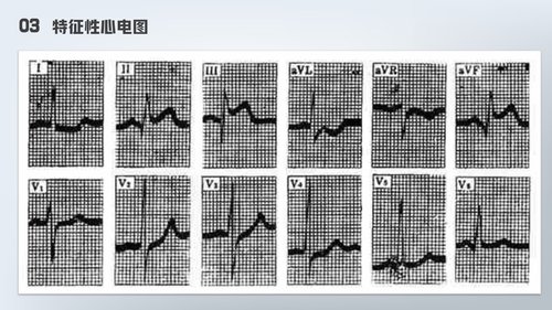 a0177 急性心梗护理查房PPT课件24页可编辑无水印直接可用 第17页