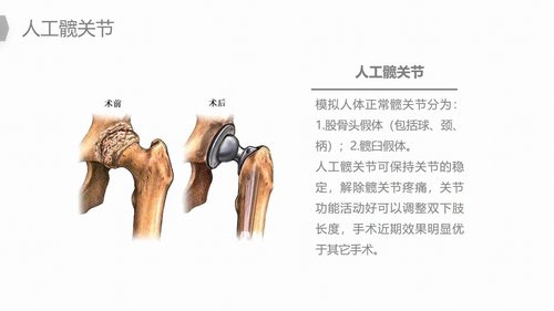 a0187 换人工髋关节预防深静脉血栓护理PPT课件22页可编辑无水印直接可用 第6页