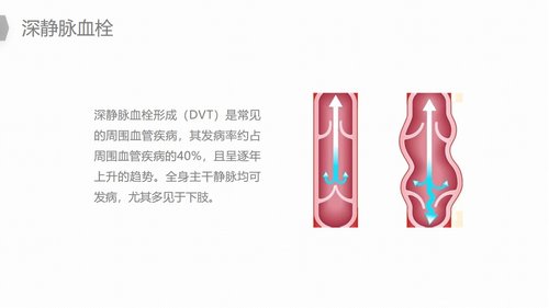 a0187 换人工髋关节预防深静脉血栓护理PPT课件22页可编辑无水印直接可用 第7页