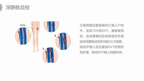 a0187 换人工髋关节预防深静脉血栓护理PPT课件22页可编辑无水印直接可用 第8页