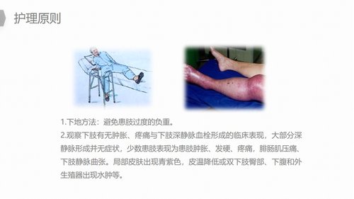 a0187 换人工髋关节预防深静脉血栓护理PPT课件22页可编辑无水印直接可用 第15页