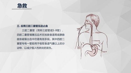 a0199 消化道大出血急救与护理知识课件PPT课件23页可编辑无水印直接可用 第11页