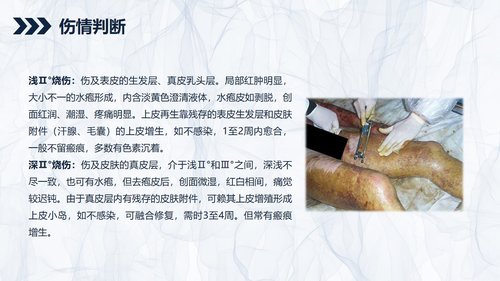 a0201 烧伤患者护理查房PPT课件44页可编辑无水印直接可用 第3页