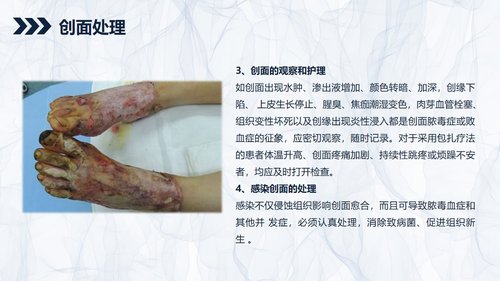a0201 烧伤患者护理查房PPT课件44页可编辑无水印直接可用 第7页