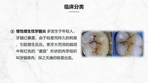 a0202 牙髓炎患者的护理查房知识课件PPT课件32页可编辑无水印直接可用 第4页