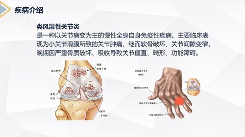 a0205 类风湿性关节炎护理查房PPT课件28页可编辑无水印直接可用 第4页