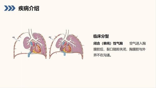a0210 结核性胸膜炎自发性气胸护理查房PPT课件38页可编辑无水印直接可用 第6页