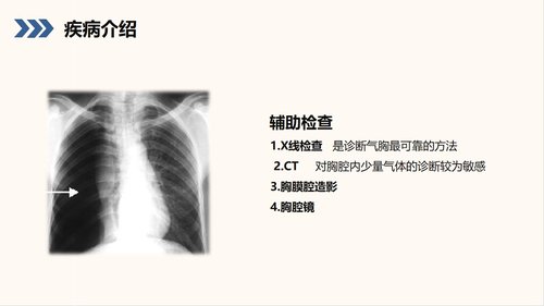 a0210 结核性胸膜炎自发性气胸护理查房PPT课件38页可编辑无水印直接可用 第7页