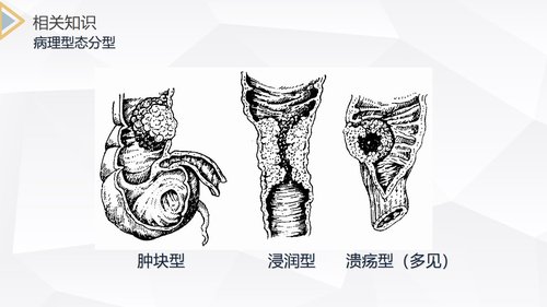 a0213 结肠癌直肠癌护理PPT课件69页可编辑无水印直接可用 第4页