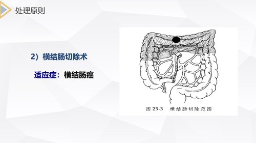 a0213 结肠癌直肠癌护理PPT课件69页可编辑无水印直接可用 第12页