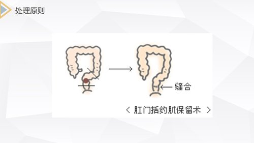 a0213 结肠癌直肠癌护理PPT课件69页可编辑无水印直接可用 第13页