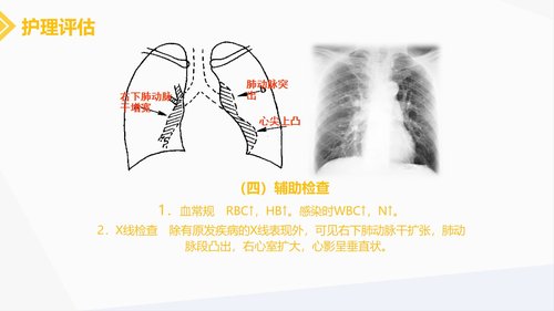 a0216 肺源性心脏病病人的护理PPT课件30页可编辑无水印直接可用 第11页