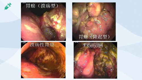 a0224 胃癌的护理查房2PPT课件30页可编辑无水印直接可用 第11页