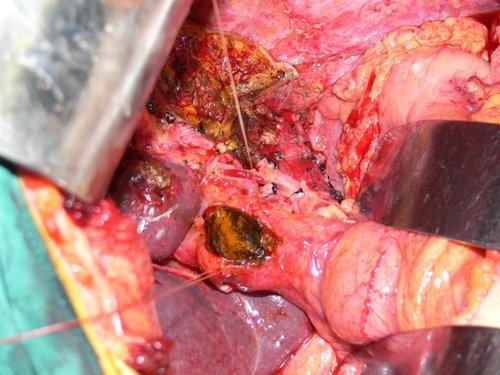 a0225 胆总管结石护理ppt课件PPT课件35页可编辑无水印直接可用 第7页