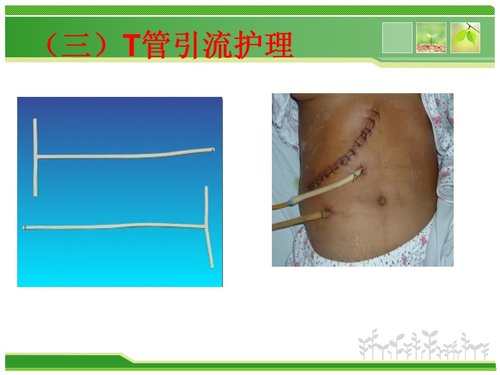 a0226 胆总管结石护理查房PPT课件43页可编辑无水印直接可用 第11页