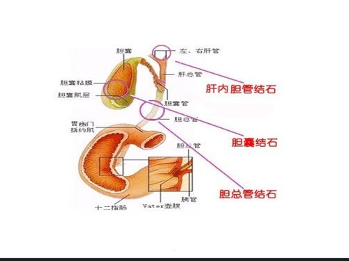 a0227 胆总管结石护理查房完整版PPT课件36页可编辑无水印直接可用 第5页