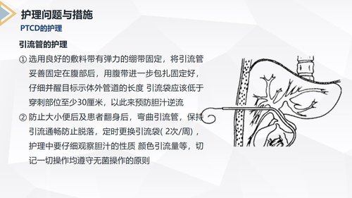 a0229 胰腺癌患者护理查房PPT课件40页可编辑无水印直接可用 第17页