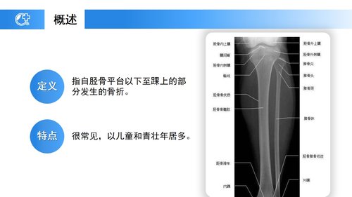 a0238 蓝色医疗模板-胫腓骨骨折护理PPT课件23页可编辑无水印直接可用 第4页