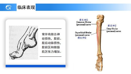 a0238 蓝色医疗模板-胫腓骨骨折护理PPT课件23页可编辑无水印直接可用 第8页