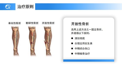 a0238 蓝色医疗模板-胫腓骨骨折护理PPT课件23页可编辑无水印直接可用 第10页