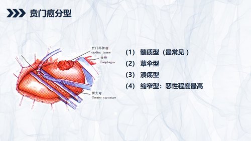 a0240 贲门癌伴脓胸吻合口瘘护理查房PPT课件43页可编辑无水印直接可用 第4页