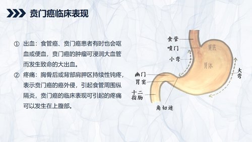 a0240 贲门癌伴脓胸吻合口瘘护理查房PPT课件43页可编辑无水印直接可用 第5页