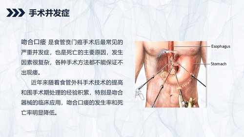 a0240 贲门癌伴脓胸吻合口瘘护理查房PPT课件43页可编辑无水印直接可用 第9页