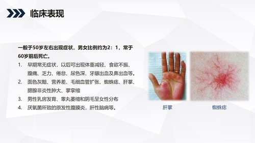 a0242 酒精性肝硬化护理教学查房PPT课件36页可编辑无水印直接可用 第7页