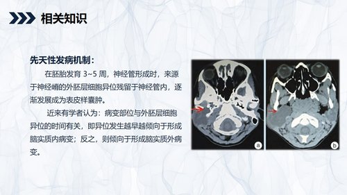 a0245 颅内表皮样囊肿患者的护理查房PPT课件31页可编辑无水印直接可用 第4页