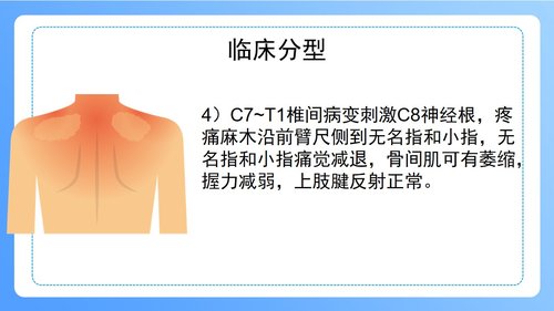 a0247 颈椎病病人的护理PPT课件47页可编辑无水印直接可用 第6页