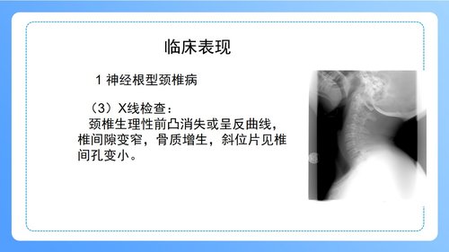 a0247 颈椎病病人的护理PPT课件47页可编辑无水印直接可用 第9页