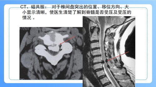 a0247 颈椎病病人的护理PPT课件47页可编辑无水印直接可用 第11页