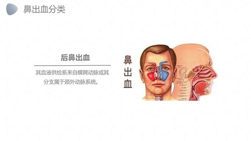 a0249 鼻出血护理诊断措施业务PPT课件27页可编辑无水印直接可用 第4页