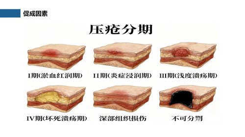 a0261 压疮预防及护理（27页）PPT课件27页可编辑无水印直接可用 第12页